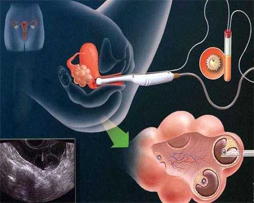 北京包成功代孕要多少钱：了解输卵管炎一般有哪些症状